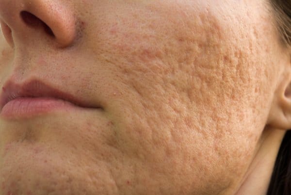 Acne scars improve after topical Platelet rich plasma