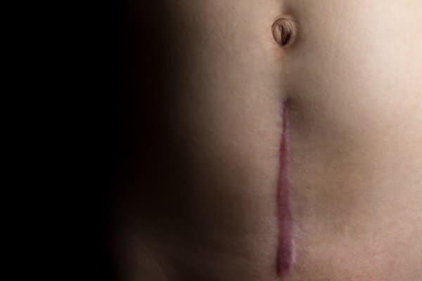 A recovering scar from a c-section operation