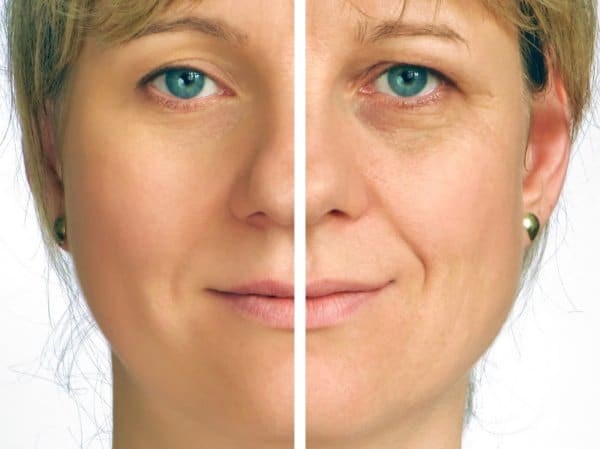 PRP for skin rejuvenation improves the appearance of wrinkles