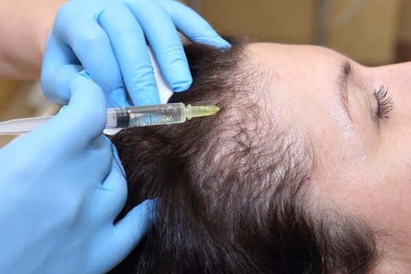 woman receiving PRP injection for hair loss